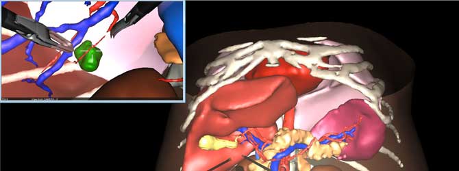 https://ircad-develop.b-cdn.net/Liver-planning2.jpg